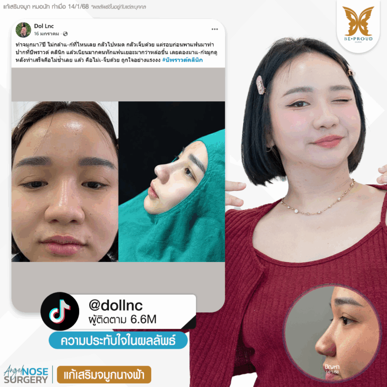 บีพราวด์ คลินิก (Beproud Clinic) ภาพรีวิวเปรียบเทียบก่อนทำและหลังทำศัลยกรรมจมูกของอินฟลูเอนเซอร์เจ๊ตับฉ่ำโบ๊ะ @dollnc ทำจมูกกับหมอนัท ที่บีพราวด์คลินิก