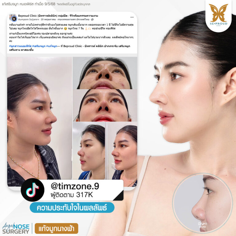 บีพราวด์ คลินิก (Beproud Clinic) รีวิวศัลยกรรมแก้จมูกนางฟ้าคุณ @timzone.9 แสดงภาพก่อนทำและหลังทำจมูก กับหมอเฟิร์ส ที่บีพราวด์คลินิก