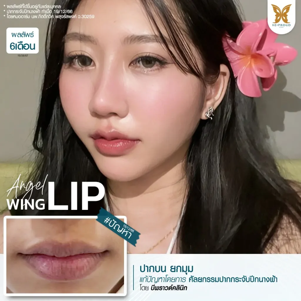 อัปเดต 2025! ปากกระจับ ราคาเท่าไหร่? เจาะลึกทุกเรื่องที่ BEPROUD Clinic ปากกระจับ ราคา อัปเดต 2025! ปากกระจับ ราคาเท่าไหร่? เจาะลึกทุกเรื่องที่ BEPROUD Clinic