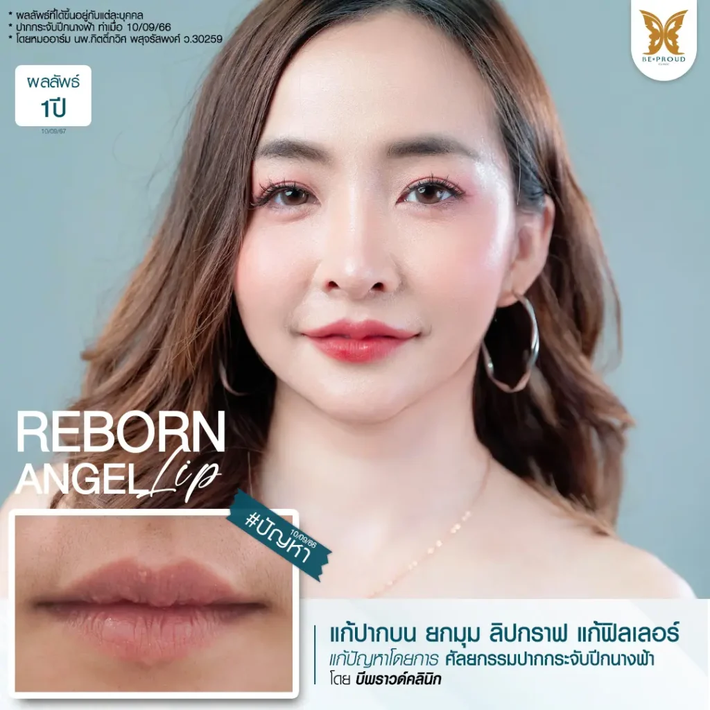 อัปเดต 2025! ปากกระจับ ราคาเท่าไหร่? เจาะลึกทุกเรื่องที่ BEPROUD Clinic ปากกระจับ ราคา อัปเดต 2025! ปากกระจับ ราคาเท่าไหร่? เจาะลึกทุกเรื่องที่ BEPROUD Clinic