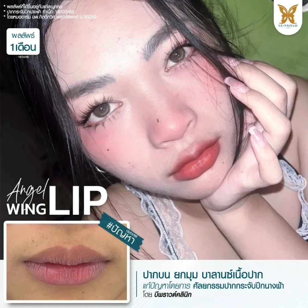 อัปเดต 2025! ปากกระจับ ราคาเท่าไหร่? เจาะลึกทุกเรื่องที่ BEPROUD Clinic ปากกระจับ ราคา อัปเดต 2025! ปากกระจับ ราคาเท่าไหร่? เจาะลึกทุกเรื่องที่ BEPROUD Clinic