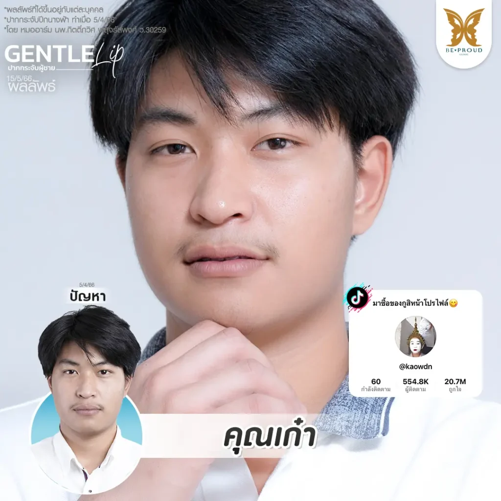 อัปเดต 2025! ปากกระจับ ราคาเท่าไหร่? เจาะลึกทุกเรื่องที่ BEPROUD Clinic ปากกระจับ ราคา อัปเดต 2025! ปากกระจับ ราคาเท่าไหร่? เจาะลึกทุกเรื่องที่ BEPROUD Clinic
