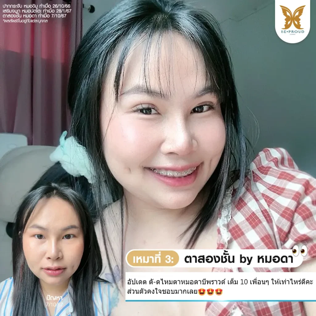 กรงใจที่แปลว่าตรงใจ ยกเครื่องหน้าใหม่ที่บีพราวด์คลินิก หน้าใหม่ กรงใจที่แปลว่าตรงใจ ยกเครื่องหน้าใหม่ที่บีพราวด์คลินิก