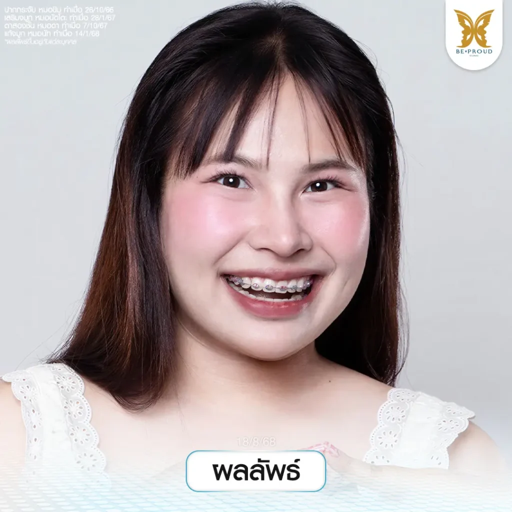 กรงใจที่แปลว่าตรงใจ ยกเครื่องหน้าใหม่ที่บีพราวด์คลินิก หน้าใหม่ กรงใจที่แปลว่าตรงใจ ยกเครื่องหน้าใหม่ที่บีพราวด์คลินิก