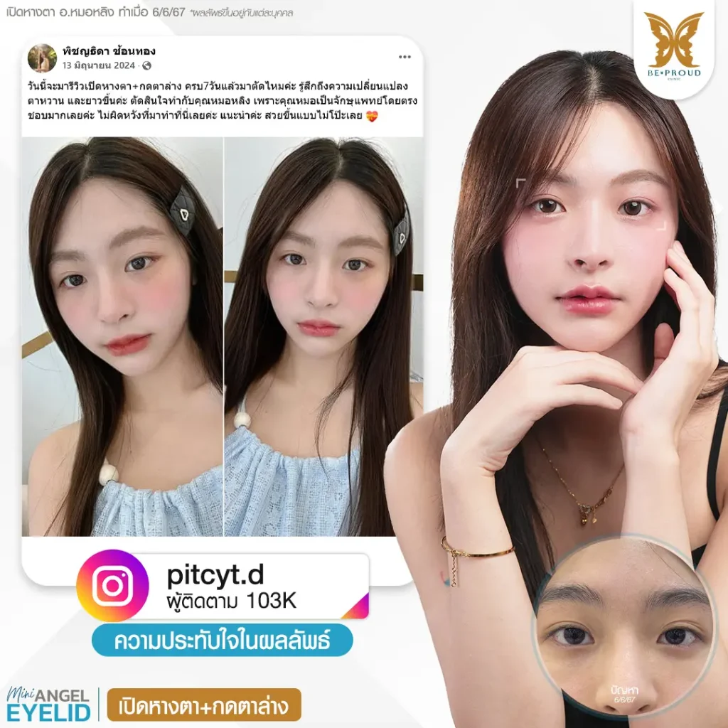 รีวิวเปิดหางตา กดตาล่าง ให้ตากลมแบ๊ว ฉบับทำที่ไทย เปิดหางตา กดตาล่าง รีวิวเปิดหางตา กดตาล่าง ให้ตากลมแบ๊ว ฉบับทำที่ไทย