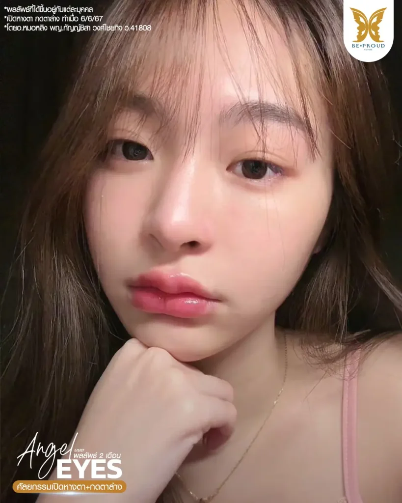 รีวิวเปิดหางตา กดตาล่าง ให้ตากลมแบ๊ว ฉบับทำที่ไทย เปิดหางตา กดตาล่าง รีวิวเปิดหางตา กดตาล่าง ให้ตากลมแบ๊ว ฉบับทำที่ไทย