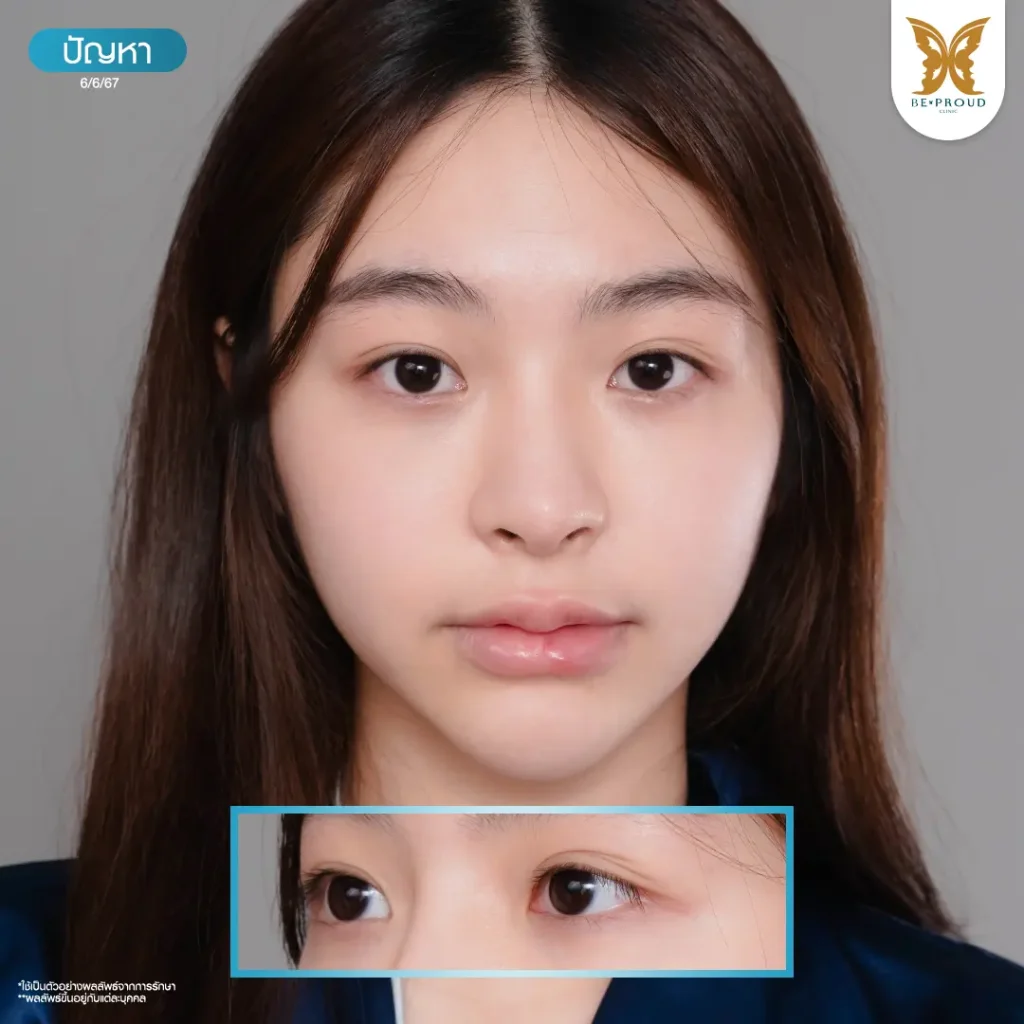 รีวิวเปิดหางตา กดตาล่าง ให้ตากลมแบ๊ว ฉบับทำที่ไทย เปิดหางตา กดตาล่าง รีวิวเปิดหางตา กดตาล่าง ให้ตากลมแบ๊ว ฉบับทำที่ไทย