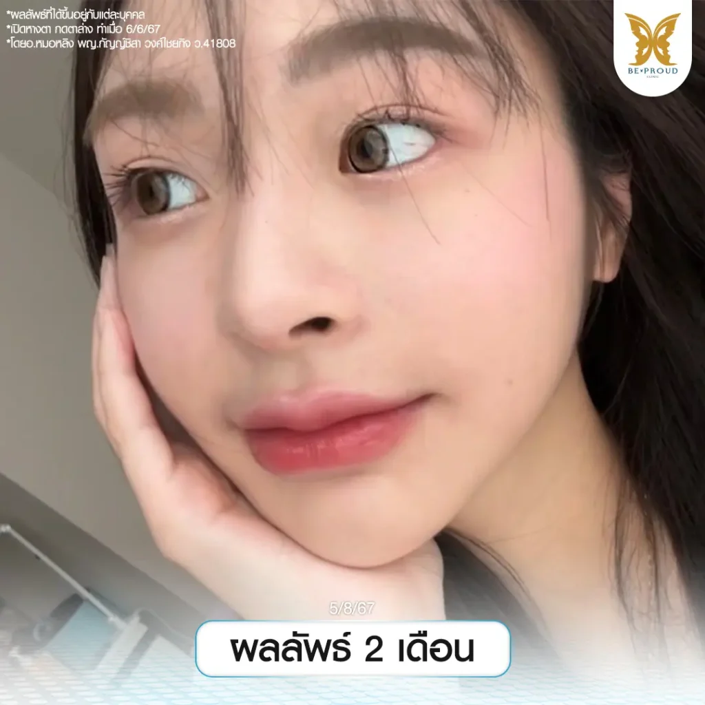 รีวิวเปิดหางตา กดตาล่าง ให้ตากลมแบ๊ว ฉบับทำที่ไทย เปิดหางตา กดตาล่าง รีวิวเปิดหางตา กดตาล่าง ให้ตากลมแบ๊ว ฉบับทำที่ไทย