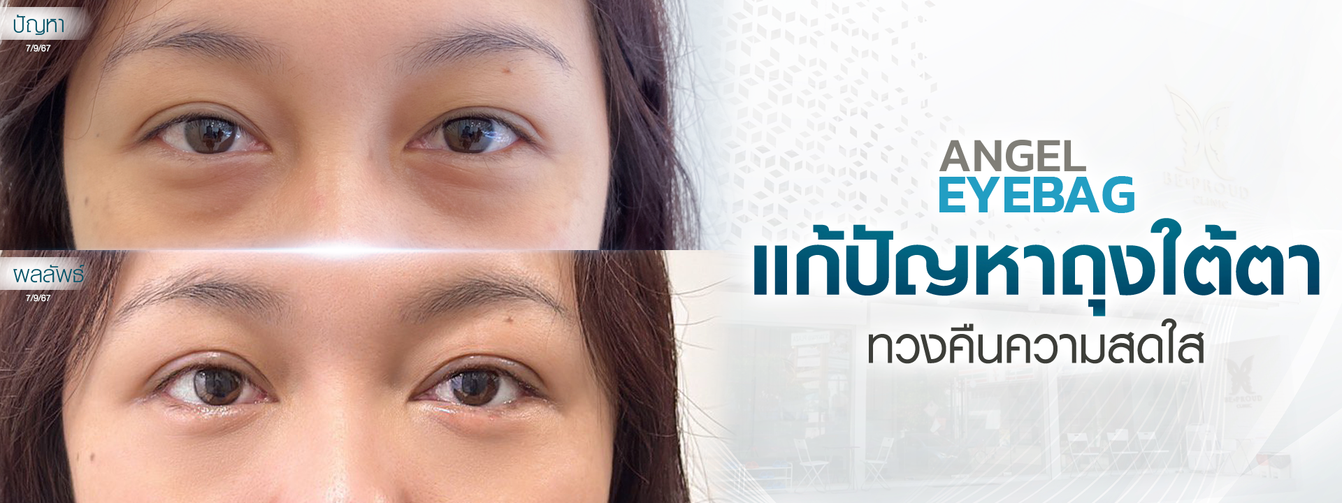 บริการ ตาสองชั้นตัดถุงใต้ตาซ่อนแผล ตัดถุงใต้ตาซ่อนแผล บริการ ตาสองชั้นตัดถุงใต้ตาซ่อนแผล