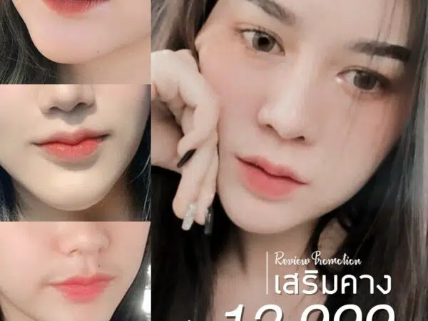 โปรเสริมคาง