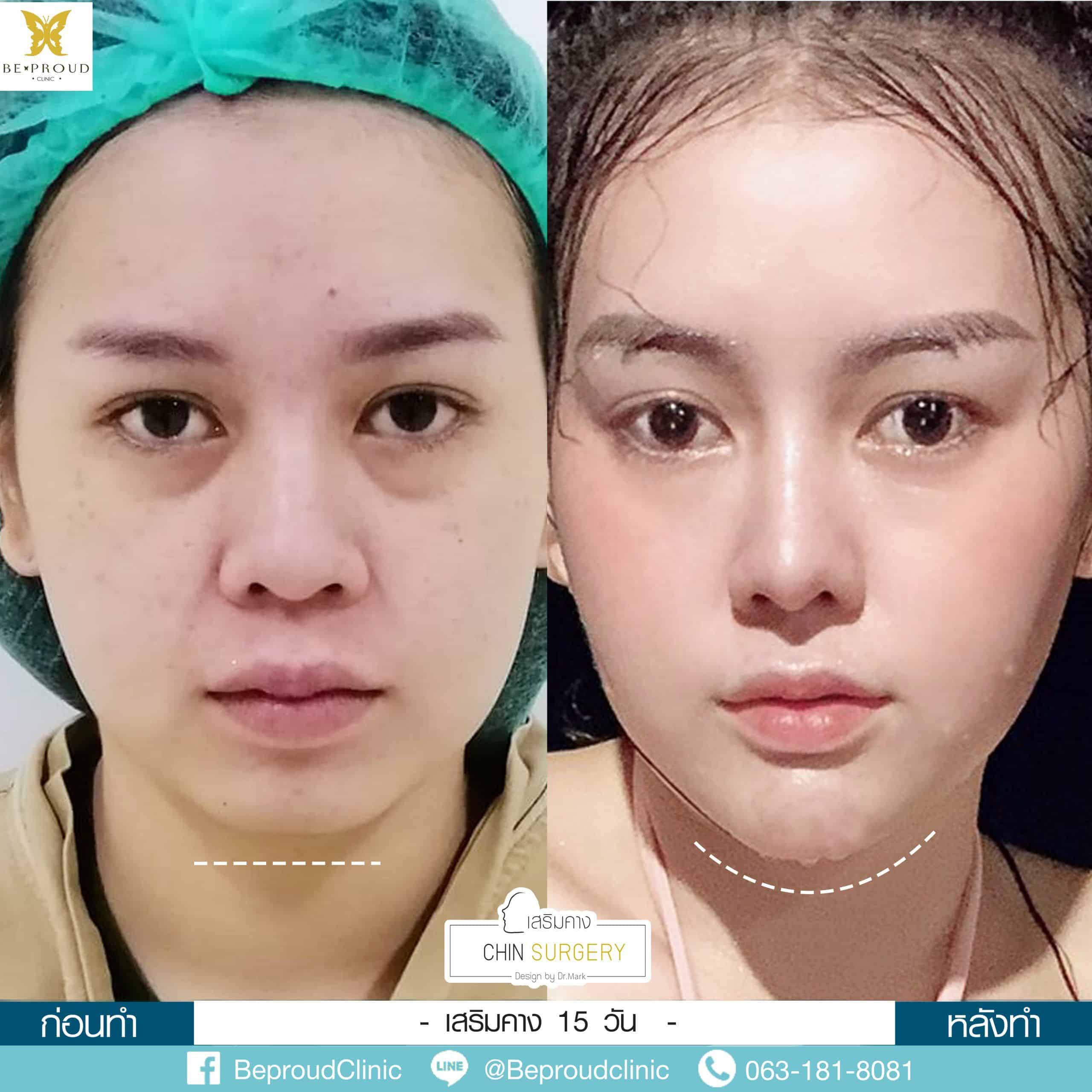 0612020 ปากกระจับ