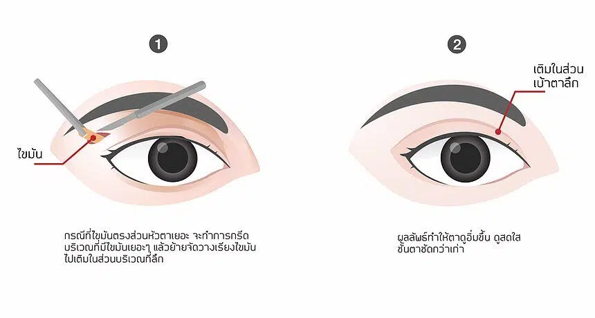 f7159c_5ae349f021944f41ade7bcf0d0030140_mv2 ตาสองชั้น รีวิวตาสองชั้น