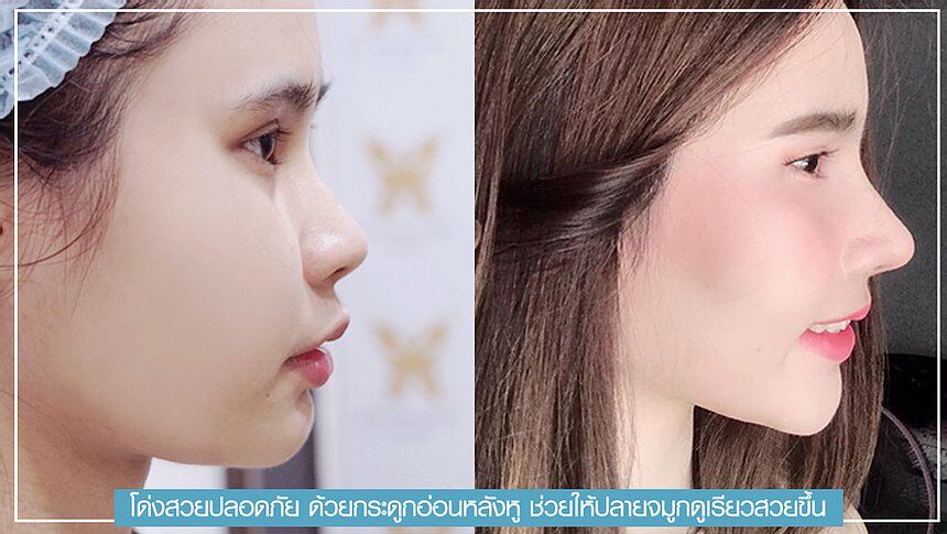 f7159c_63e2acc3fef246b283880c08e138488e_mv2 เสริมจมูก ทำจมูก วางซิลิโคน