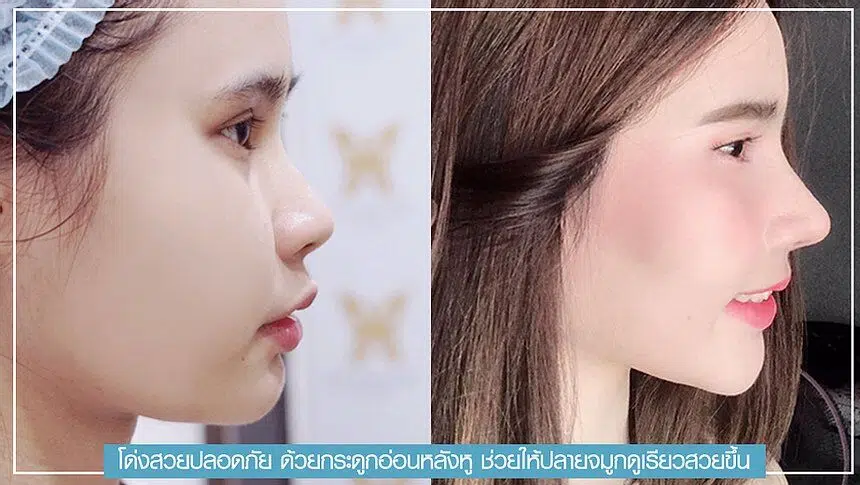 เสริมจมูก ทำจมูก วางซิลิโคน