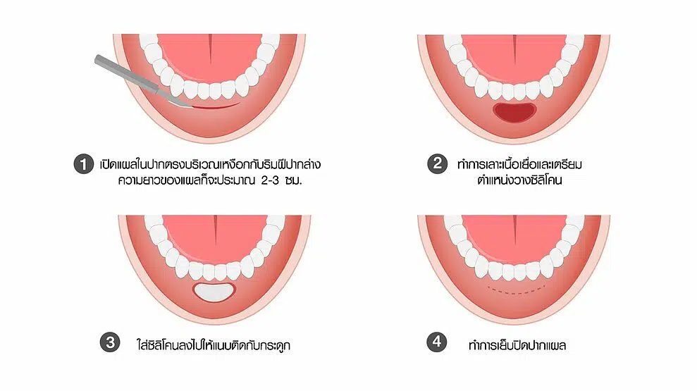 การทำคางแผลใน