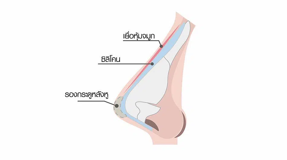 เสริมจมูก ทำจมูก วางซิลิโคน
