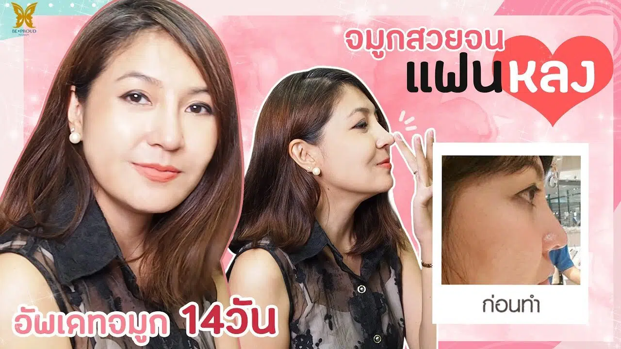 เสริมจมูก