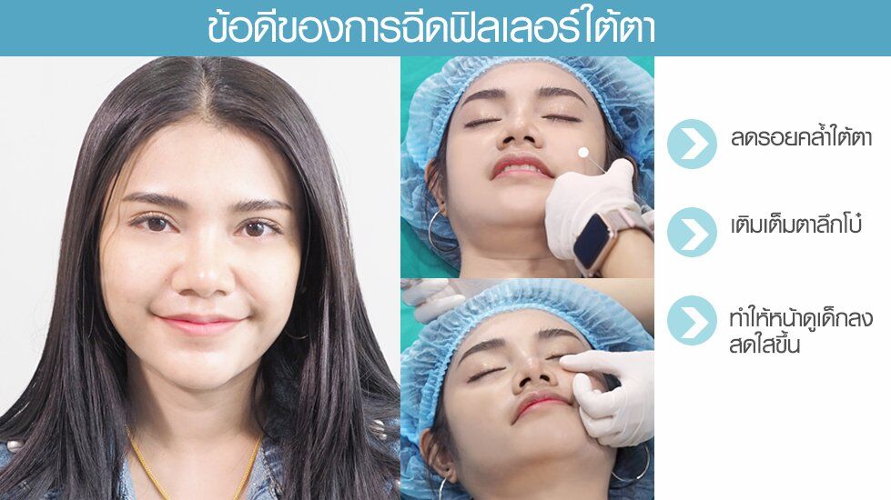 ข้อดีฟิลตา