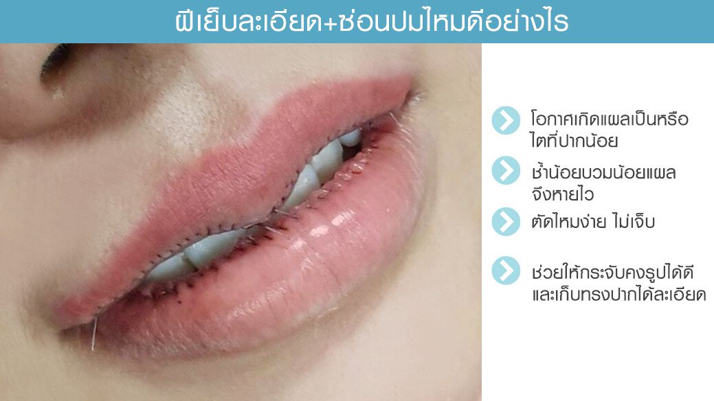 ข้แดีเย็บซ่อนปม รีวิวปากกระจับ