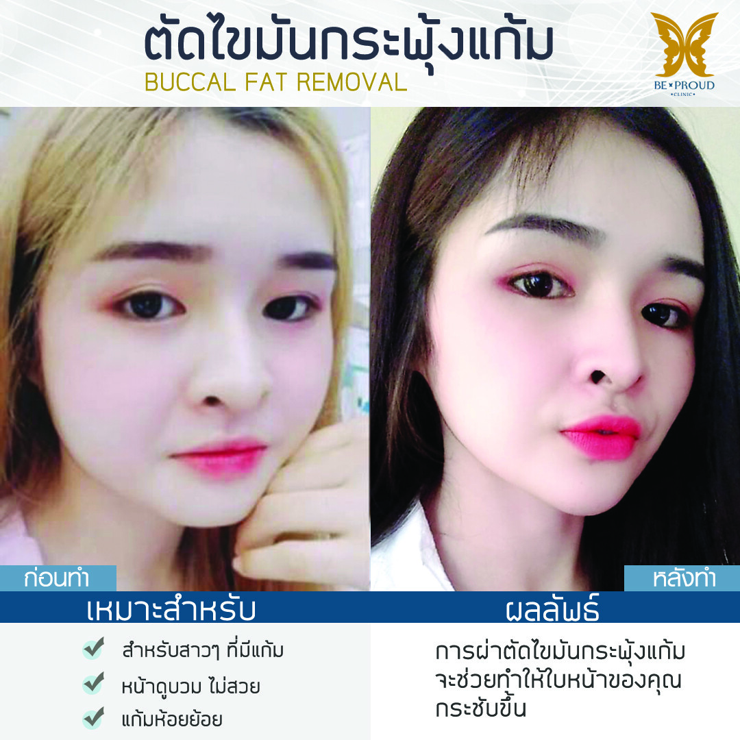 ตัดไขมันแก้ม2