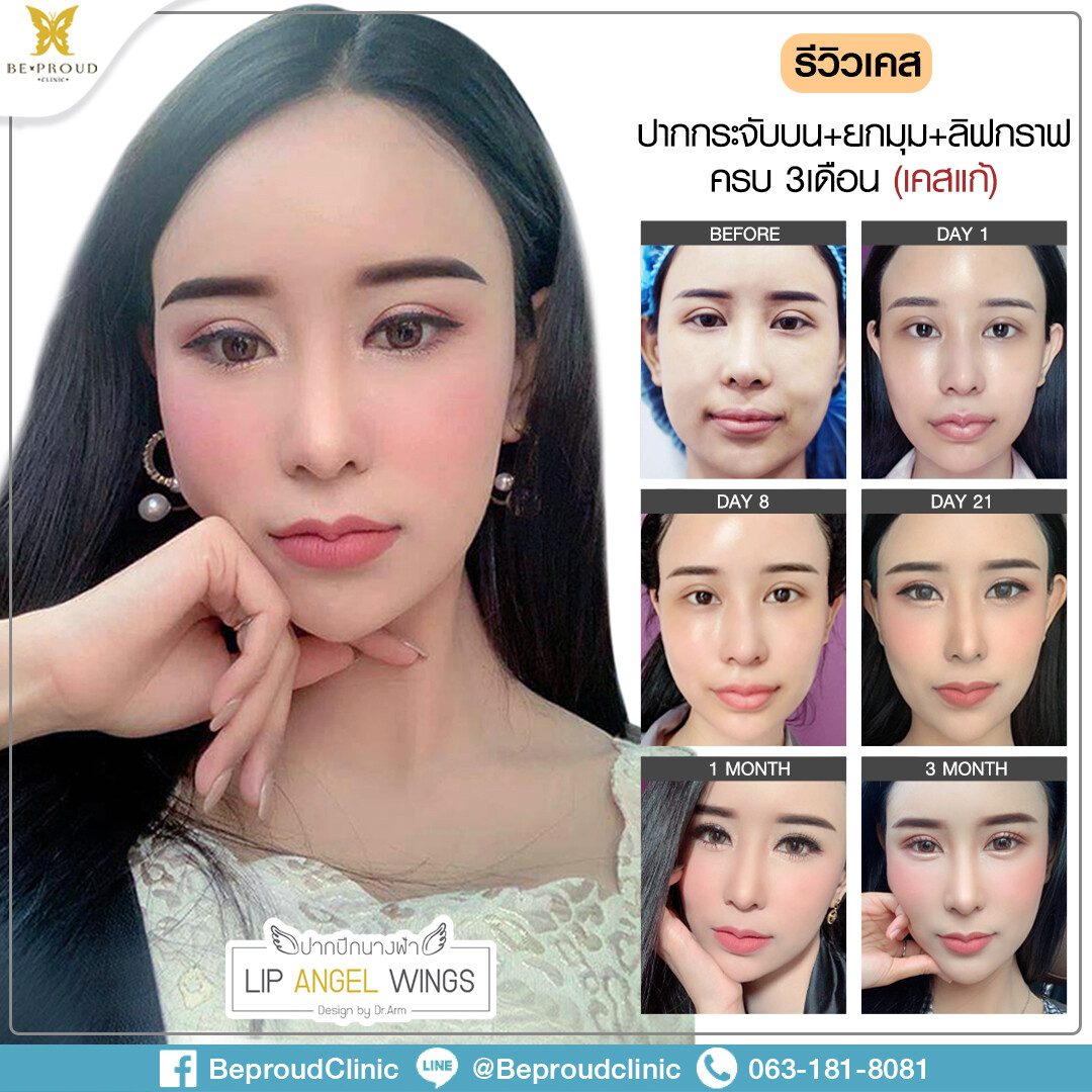 ปากการ์ตูน22042563 รีวิวปากกระจับ