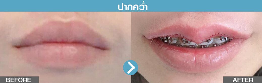 ปากคว่ำ รีวิวปากกระจับ