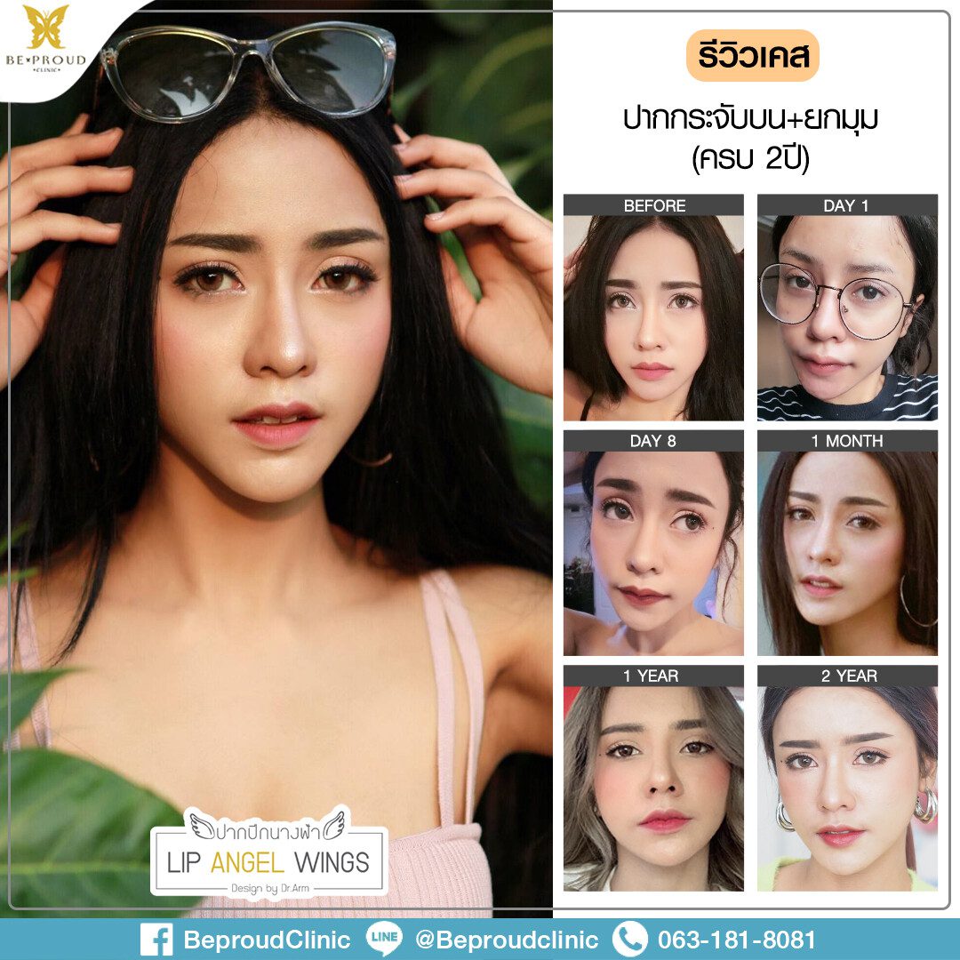 ปากสนุ๊ก30042563 รีวิวปากกระจับ