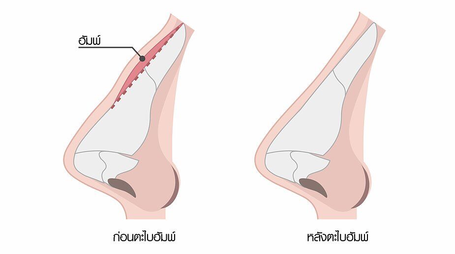 ฮัมพ์-01