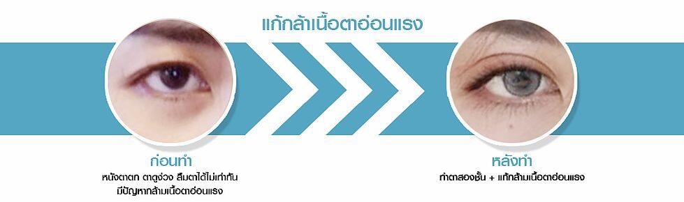 แก้กล้ามเนื้อ-แก้