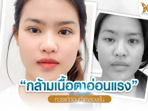 กล้ามเนื้อตาอ่อนแรง