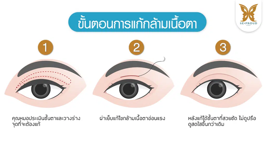 ขั้นตอนการผ่าตัดกล้ามเนื้อตา