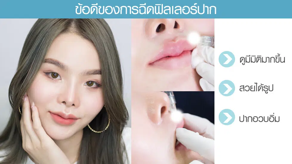 ข้อดีฟิลเลอร์ปาก ข้อดีฟิลเลอร์ปาก