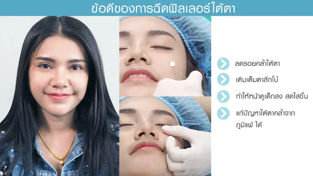 ข้อดีของฟิลเลอร์ใต้ตา ข้อดีของฟิลเลอร์ใต้ตา