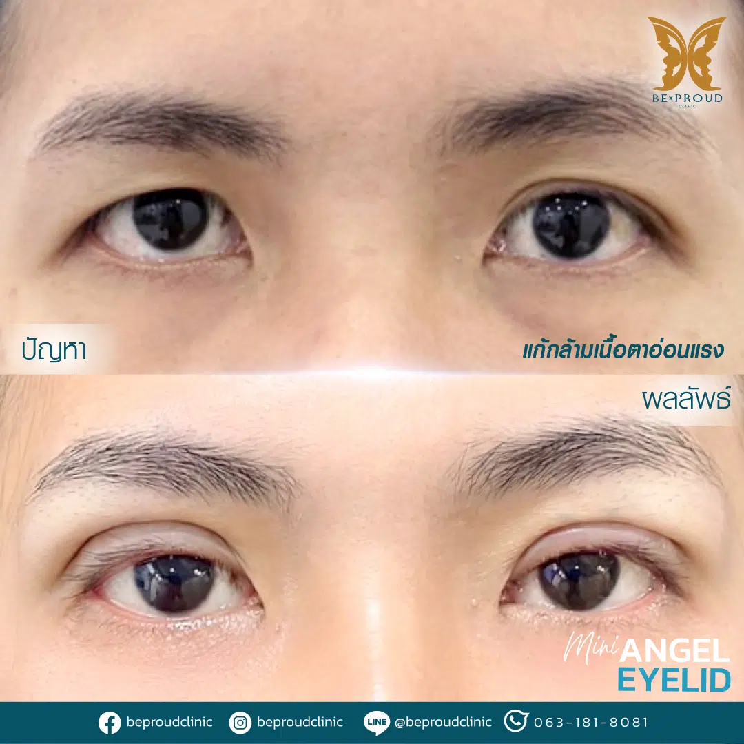 รีวิวกล้ามเนื้อตาอ่อนแรง(9)