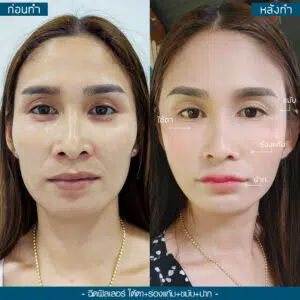 ฟิลใต้ตาขมับร่องแก้มปาก ฟิลใต้ตาขมับร่องแก้มปาก