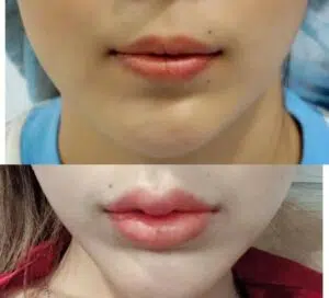 รีวิวฟิลเลอร์19