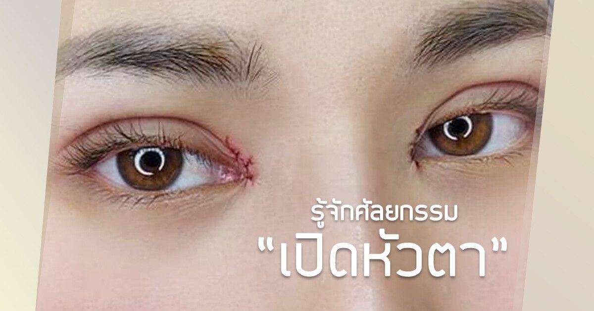 ตาสองชั้นเปิดหัวตา เปิดหัวตา