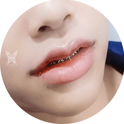เย็บถี่ซ่อนปมไหม
