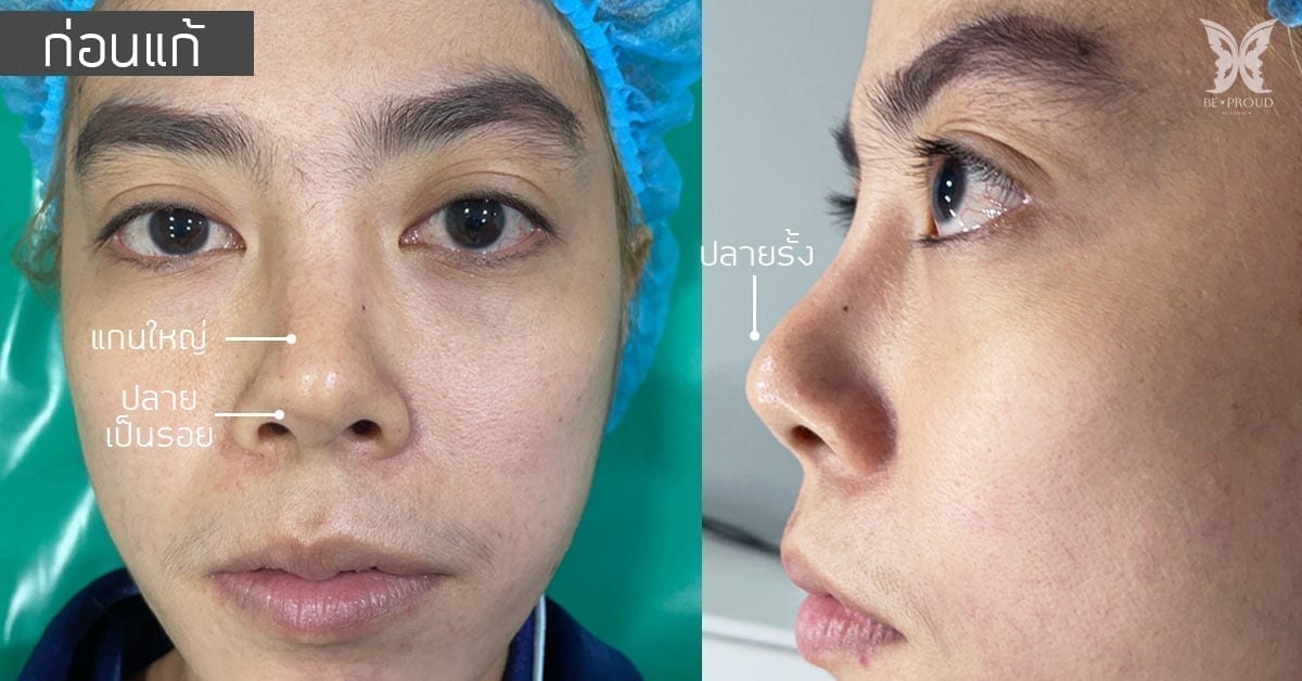 before after แก้จมูกบีพราวด์