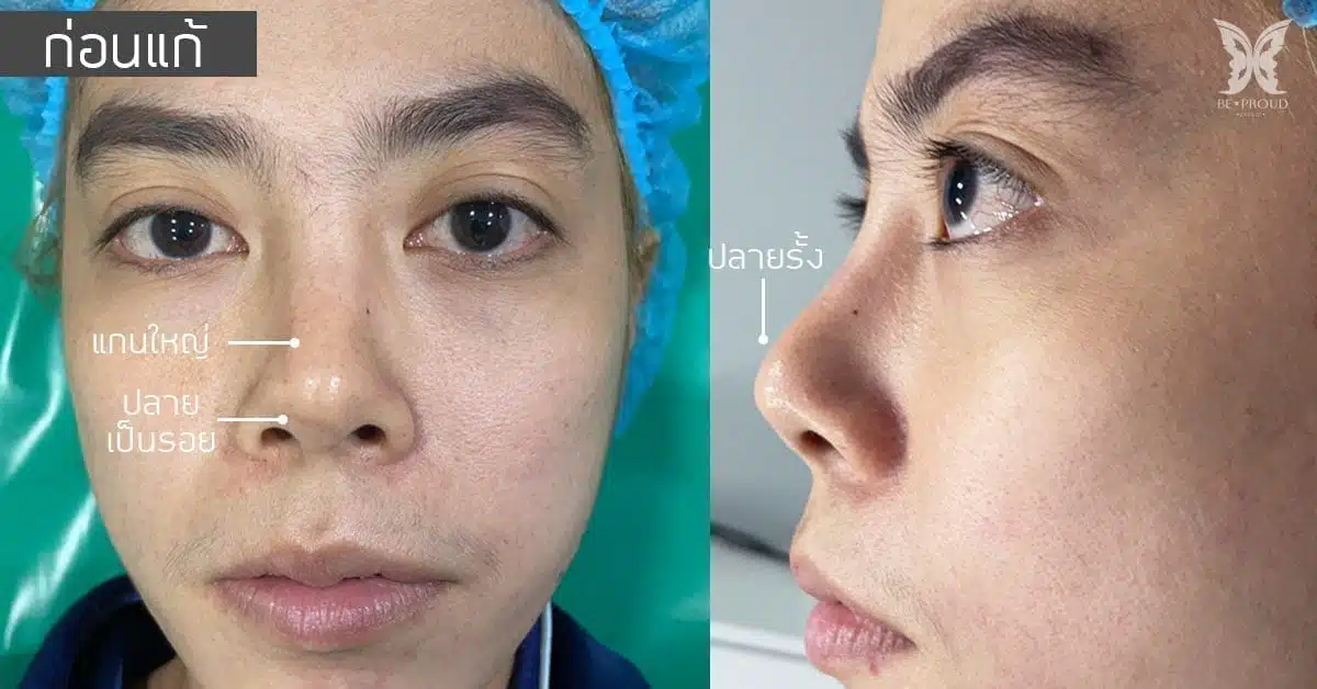 before after แก้จมูกบีพราวด์