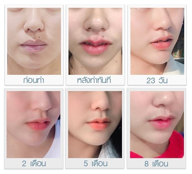 ทำปากคาง ศัลยกรรมสองอย่าง