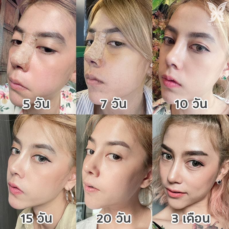 nose update รีวิวแก้จมูก