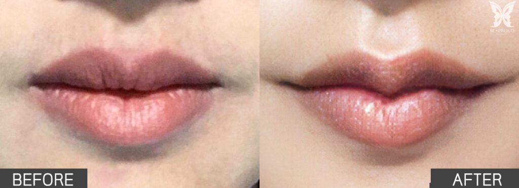 angellips01 ปากกระจับ ยกมุมปาก