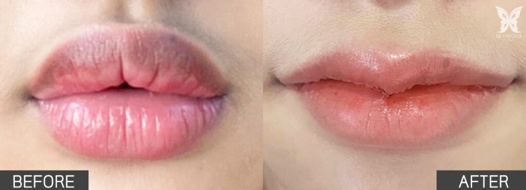 ปากกระจับ ปากหนา ปากกระจับ ปากหนา