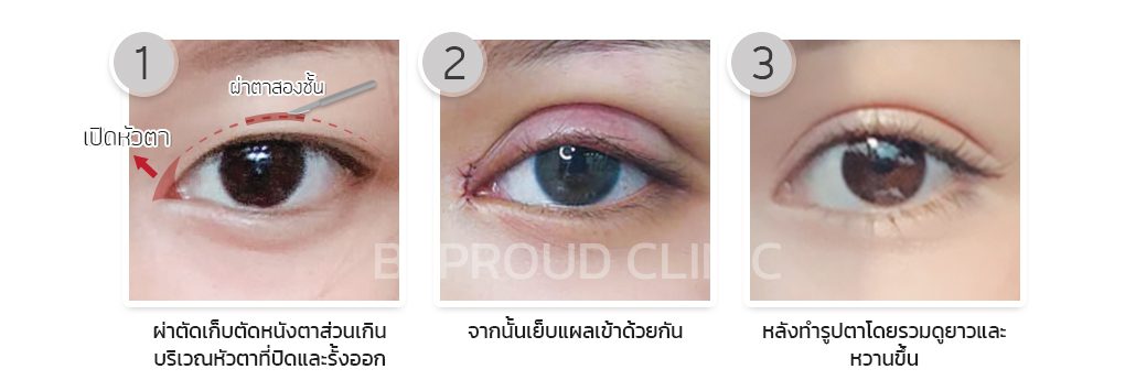 การผ่าตัดเปิดหัวตา