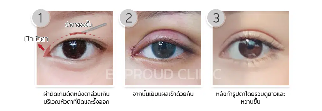 การผ่าตัดเปิดหัวตา