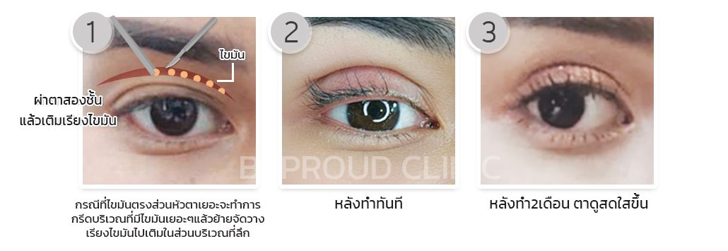 เทคนิคการเติมไขมันเบ้าตาลึก เทคนิคการเติมไขมันเบ้าตาลึก