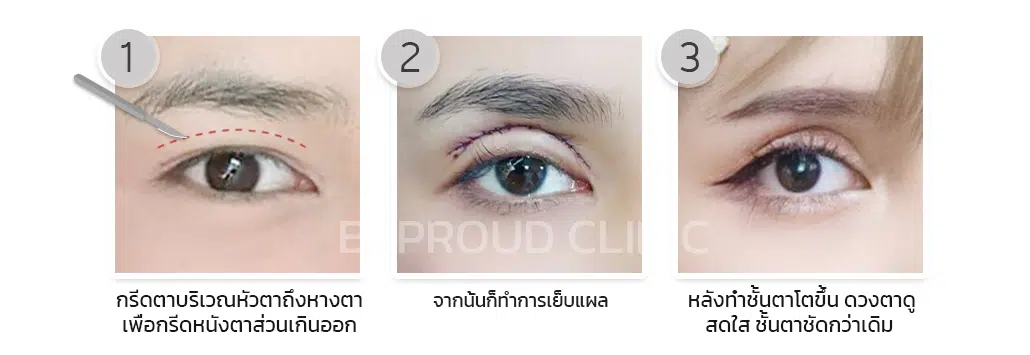 การผ่าตัดตาสองชั้นกรีดตายาว