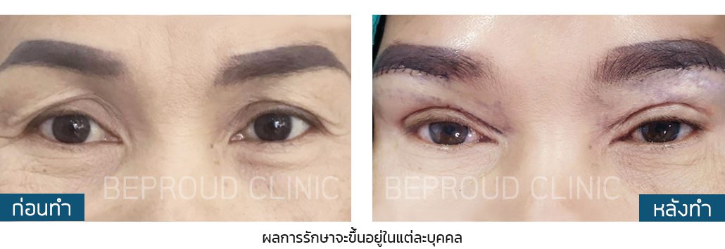 ก่อน-หลัง ยกแผลหางตาใต้คิ้ว