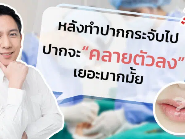การคลายตัวของปากกระจับ